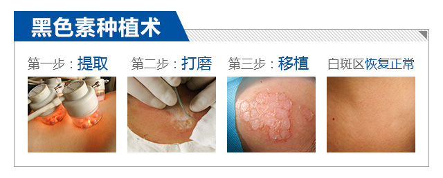 绍兴治疗白癜风费用 背部白癜风该如何治疗啊？