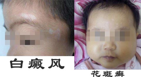 杭州华研白癜风医院介绍 女性白癜风的症状什么样?