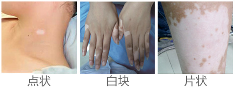 杭州好的白癜风医院分析:不同时期的白癜风病发症状有哪些