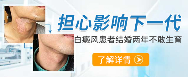 杭州治疗白癜风医院讲述 如何诊断自己身上的白癜风？