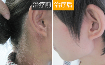 颈部白癜风对患者的危害有哪些_宁波好的白癜风医院