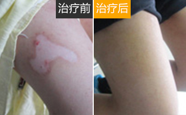 白癜风具体怎么护理好