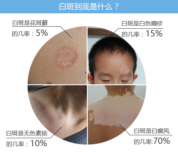 节段型白癜风的哪些危害