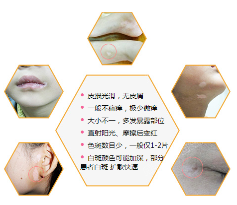宁波白癜风早期如何治疗?
