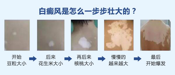 杭州好的白癜风医院告诉你:男性白癜风患者的早期症状是什么？