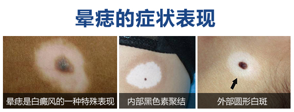 杭州白癜风医院讲述 脸部患了白癜风一般有哪些症状呢