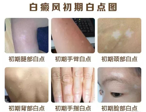 白癜风有什么症状?