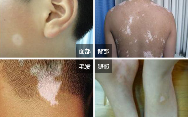 杭州小孩治疗白癜风 儿童白癜风扩散时是什么症状