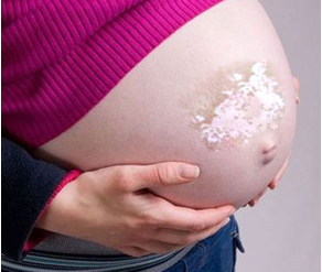 孕妇白癜风患者要注意的事项