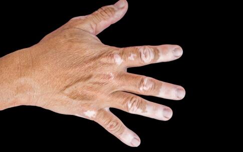 手指白癜风患处受伤如何处理