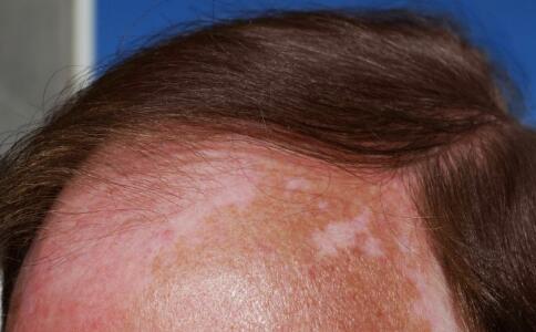 头上容易出汗如何注意白斑护理