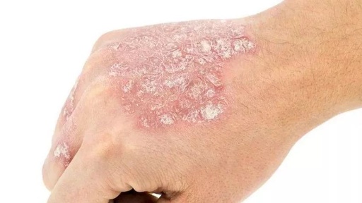 银屑病的病因有哪些?