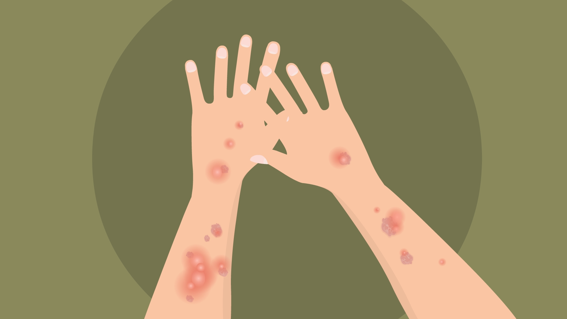 银屑病再发的要素有哪些?