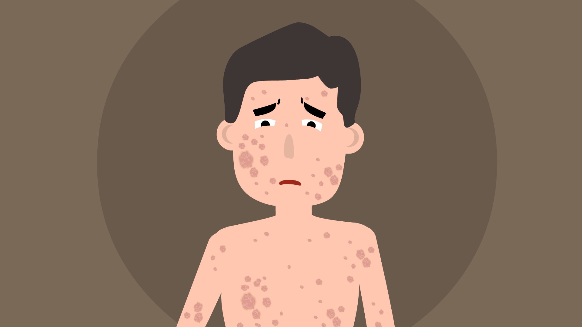 治疗男性银屑病需要注意什么?