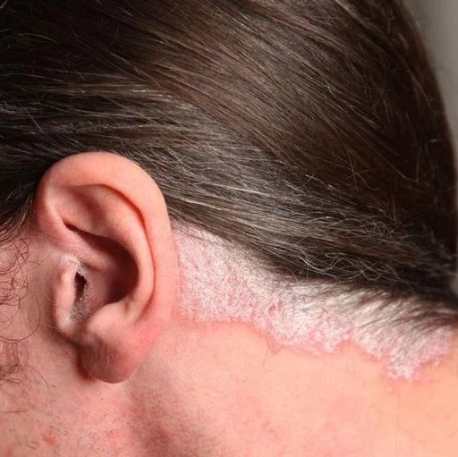 头上长了银屑病有哪些症状?