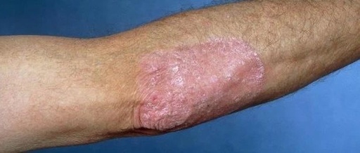 银屑病喜欢出现在患者哪些部位?