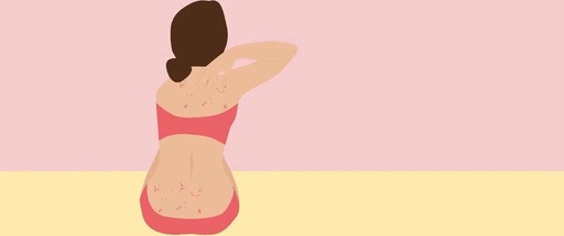 女性银屑病的病因是什么?