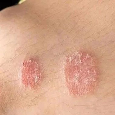 银屑病的早期症状是什么?