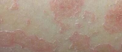 银屑病患者刮痧对病情的恢复有益吗?