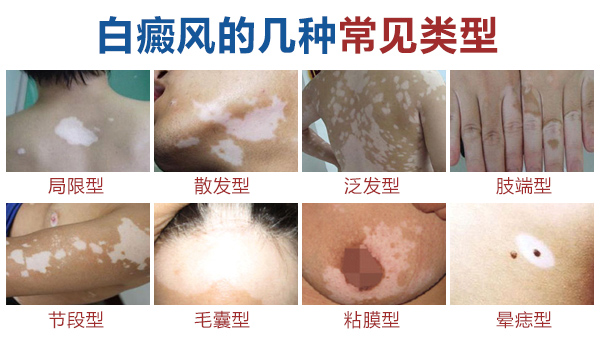 白癜风早期症状图片