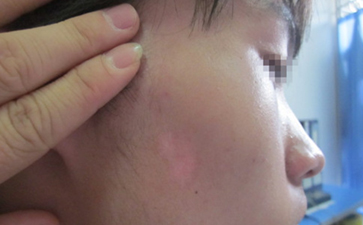 白斑病的症状有哪些