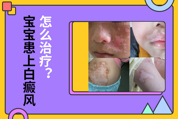宁波最好的白癜风专科医院
